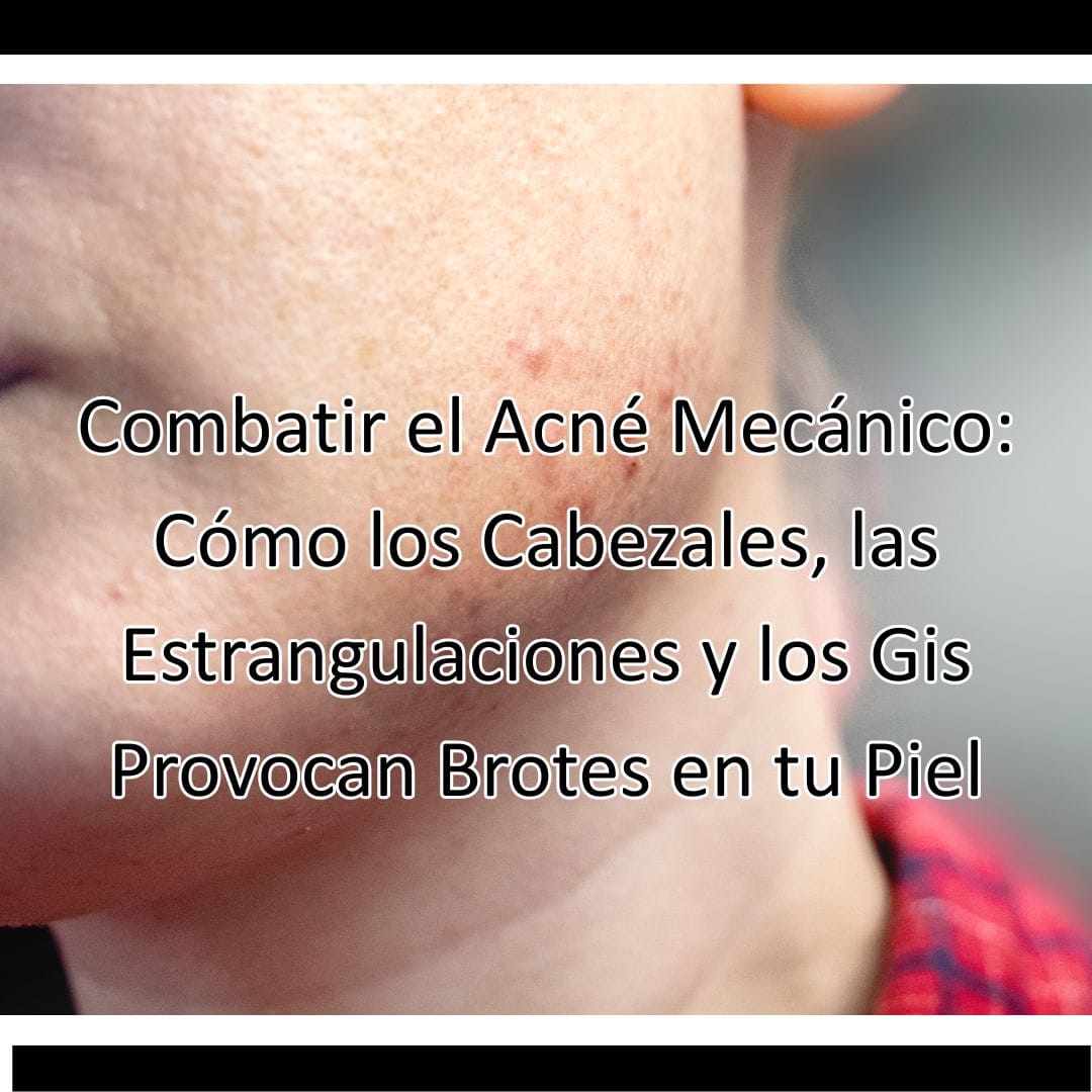Combatir el Acné Mecánico: Cómo los Cabezales, las Estrangulaciones y los Gis Provocan Brotes en tu Piel